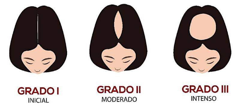 Escala Ludwig para la clasificación de la alopecia en mujeres